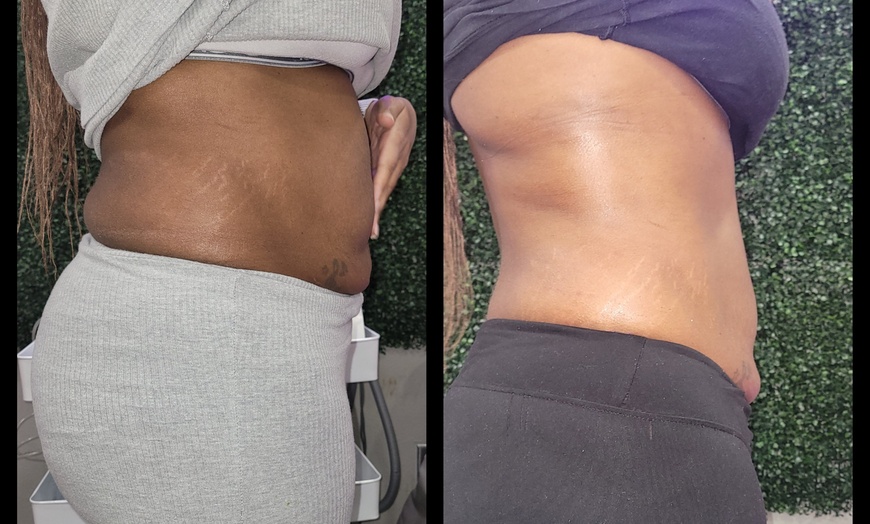 Image 3: Sculpted Curves & Revitalized Feel with Body Contouring Treatments