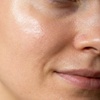 Image 4: Up to 88% Off on Microdermabrasion at Love You Laser