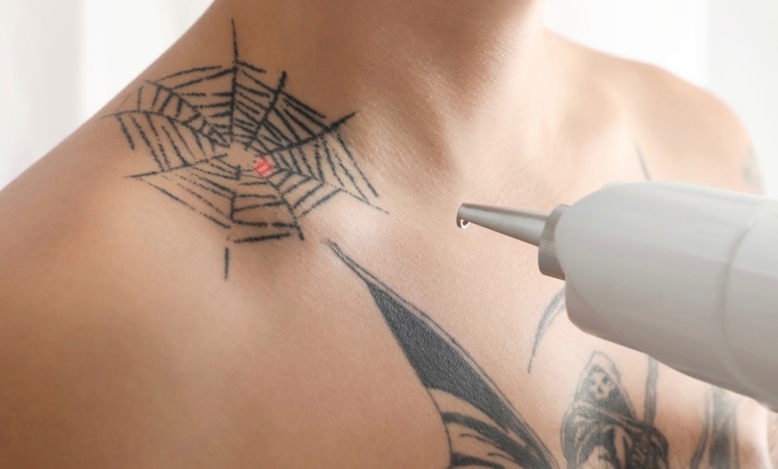 Image 2: Advanced Laser Eyebrow and Large Area Tattoo Removal Sessions