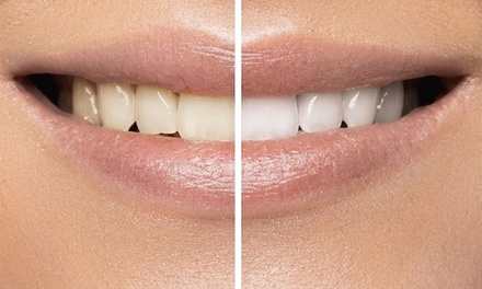 One 60-Minute Laser Teeth Whitening Session - Celebrity Smiles Aesthetic Institute + IV Therapy