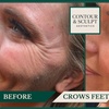 Image 1: 20-60 Units of Letybo for Frown Lines at Contour And Sculpt 