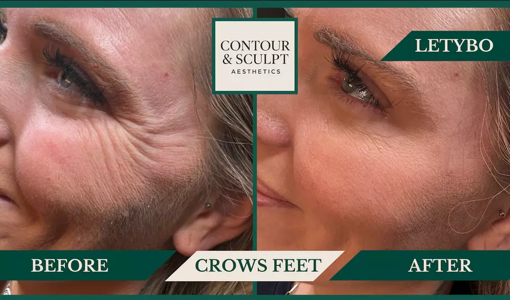 20-60 Units of Letybo for Frown Lines at Contour And Sculpt