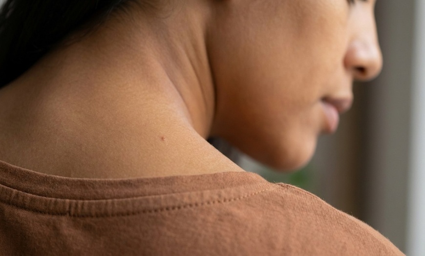 Image 5: Skin tag removal deals for Monday and individual treatments
