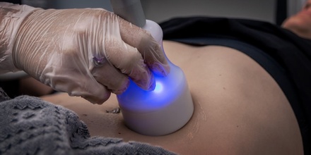 One Radio Frequency Skin Tightening Session for Face - BodMod
