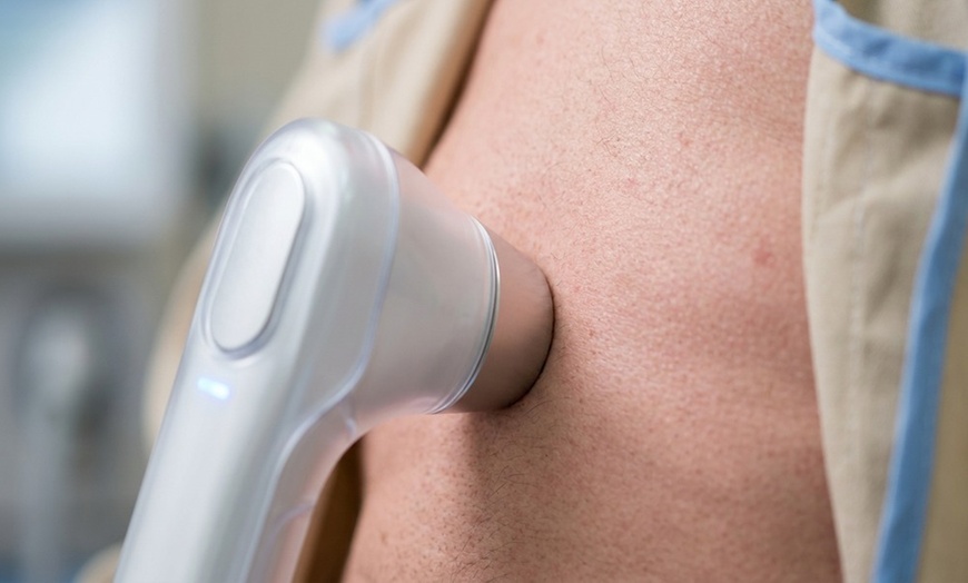 Image 4: Up to 82% Off on Fat Reduction - Non-Branded at L.A. Fat Freeze