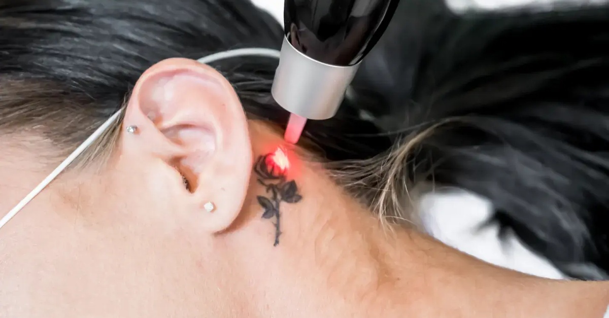 Sesiones de eliminación de tatuajes en Barcelona