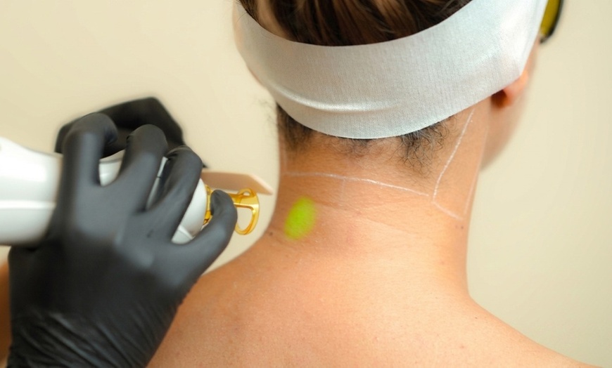 Image 2: SEV Laser: Expert Laser Hair Removal for All Skin Types in Yorba Linda