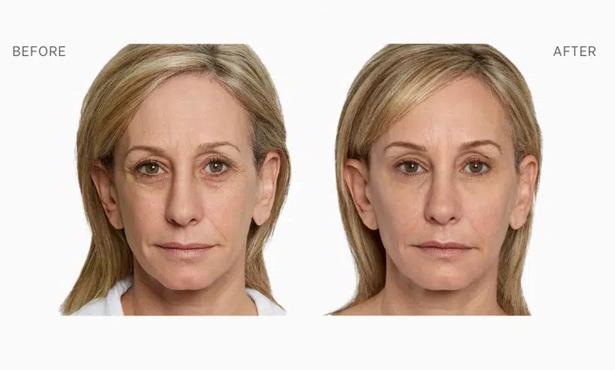Image 3: Sculptra Injection for Natural Looking Results