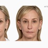 Image 3: Sculptra Injection for Natural Looking Results