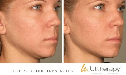 Ultherapy Treatment for Jawline - Derma Med Spa - Frisco