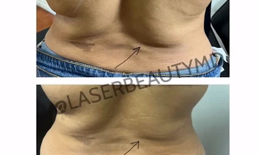 Image 2: Laser Lipo & Cavitation Sessions for Body Contouring