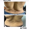 Image 2: Laser Lipo & Cavitation Sessions for Body Contouring