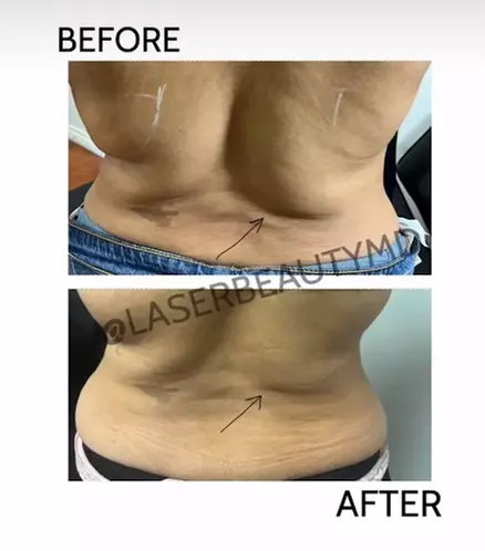 Laser Lipo & Cavitation Sessions for Body Contouring