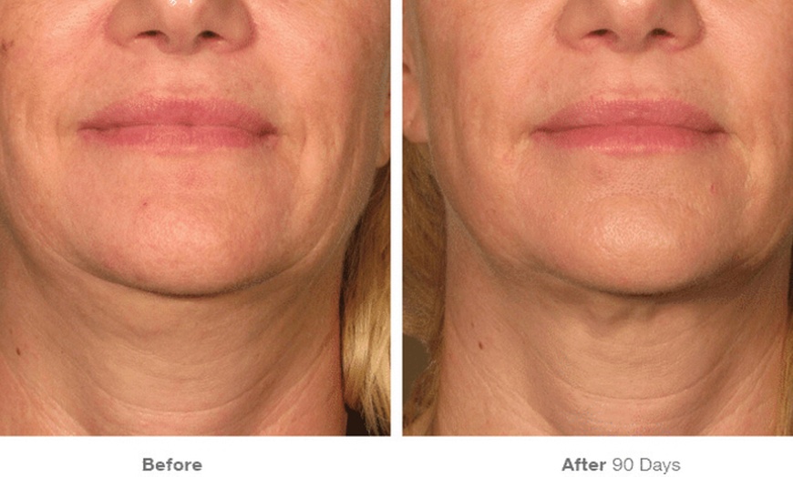 Image 6: Ultherapy: Non-Invasive Skin Lifting & Tightening for Face & Neck