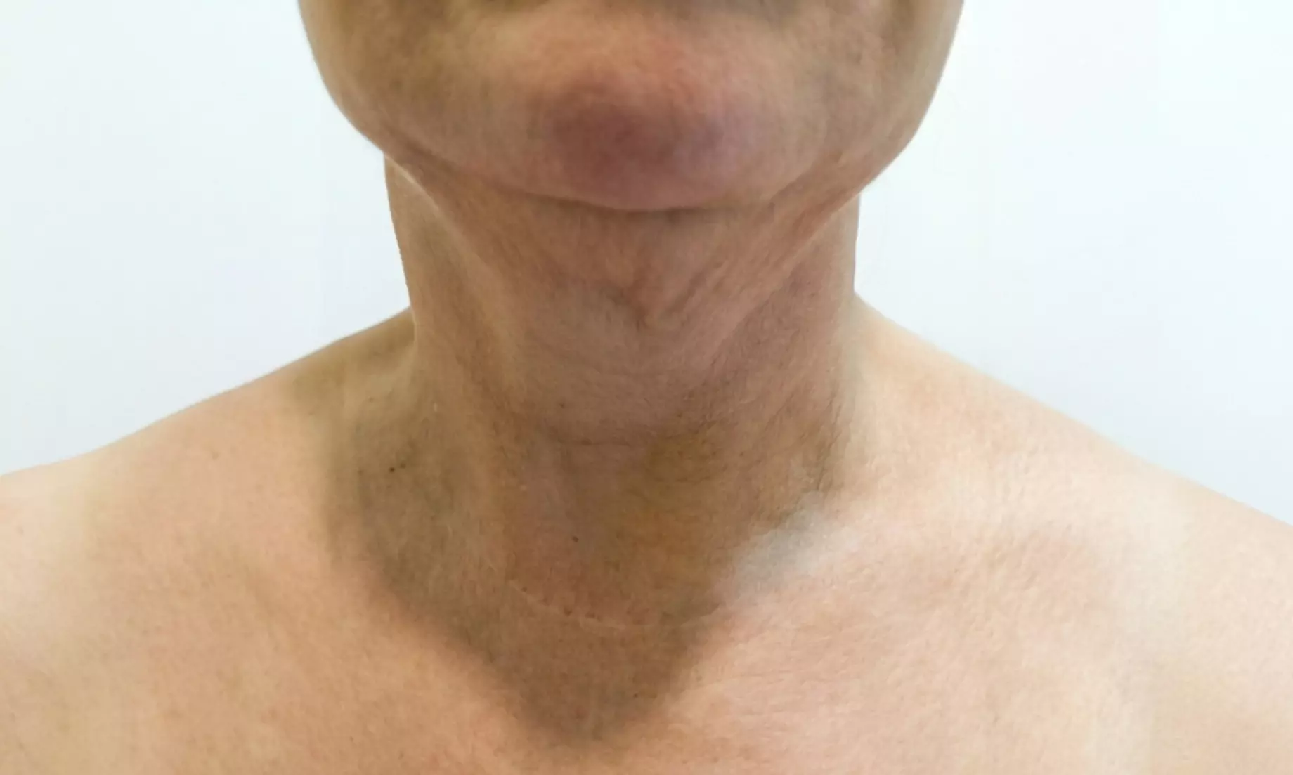 Tratamiento HIFU V10 MAX INDOLORO en rostro para 1 persona