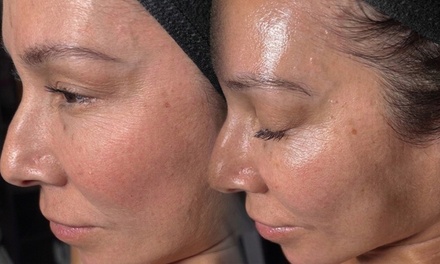 One 65 min Custom Nano Infusion Facial with Cold Therapy and Facial Massage - Oh my glow llc