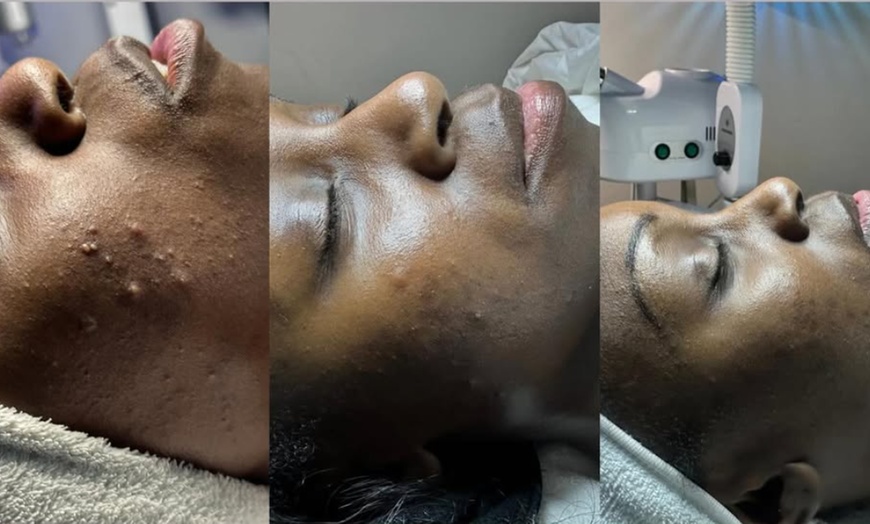 Image 3: Signature Facials & Acne Skincare Treatments | Belle’s Suite
