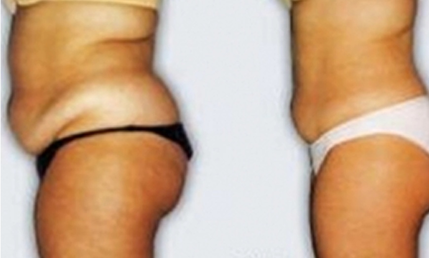 Image 11: One or Two Cavi-Lipo Fat Loss Treatments