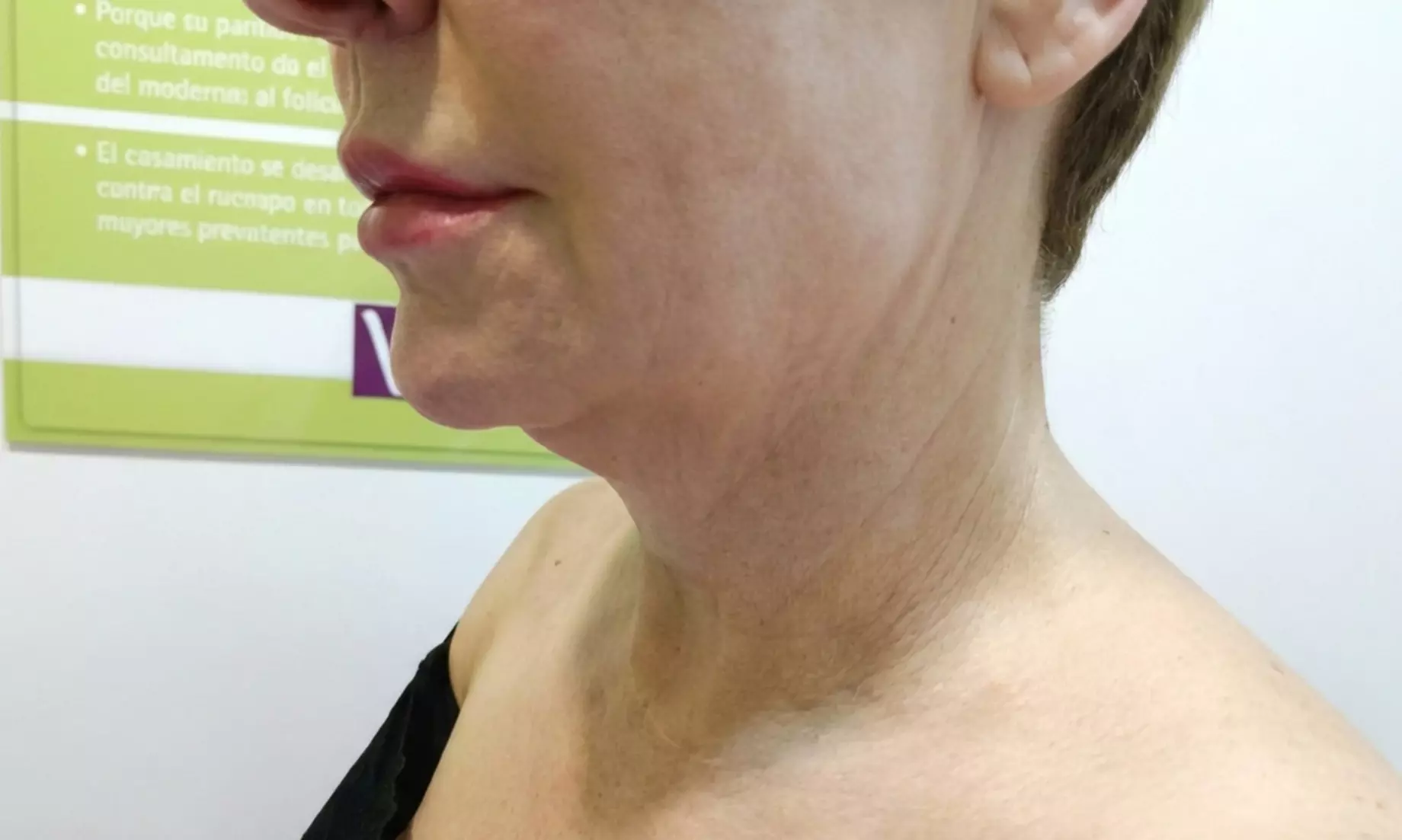 Tratamiento HIFU V10 MAX INDOLORO en rostro para 1 persona