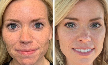 Three IPL Photofacial Sessions - A+ Day Spa - Costa Mesa, CA