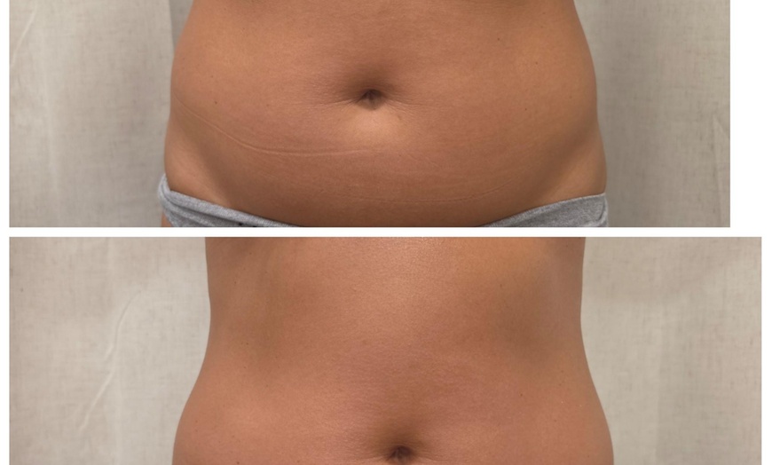 Image 3: One or Two Lymphatic Drainage with Cavitation and RF