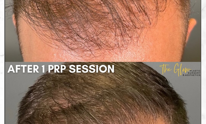 Image 4: Revitalize your Skin or Hair with Choice of PRP Treatments