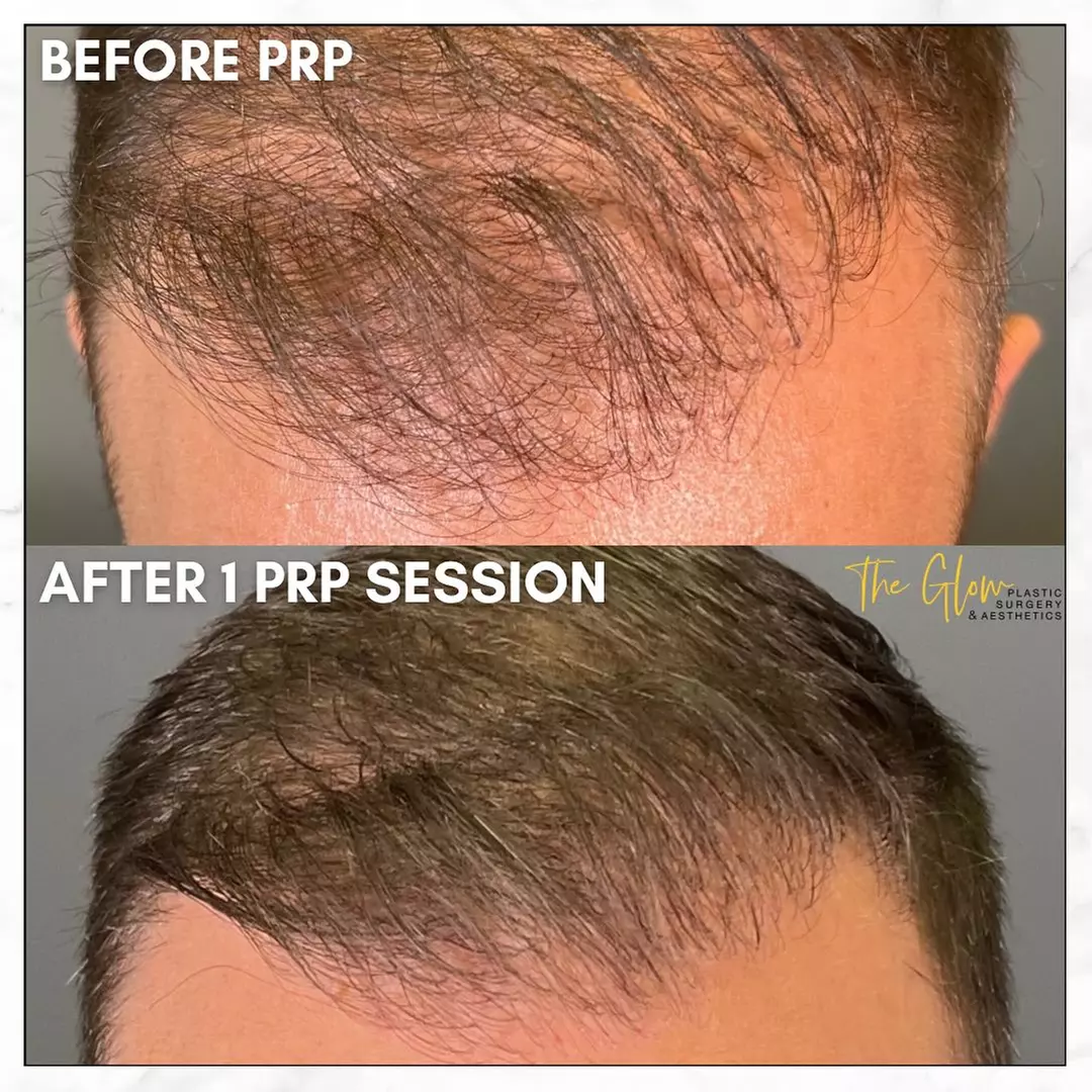Revitalize your Skin or Hair with Choice of PRP Treatments