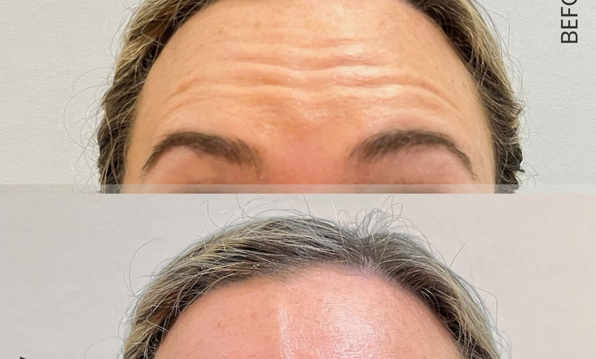 Image 14: Dermal Filler & Botulinum Toxin Treatments for Facial Rejuvenation