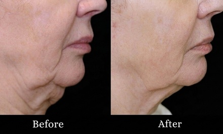 1 Skin Tightening Session (Face and Neck) - VLV Aesthetics