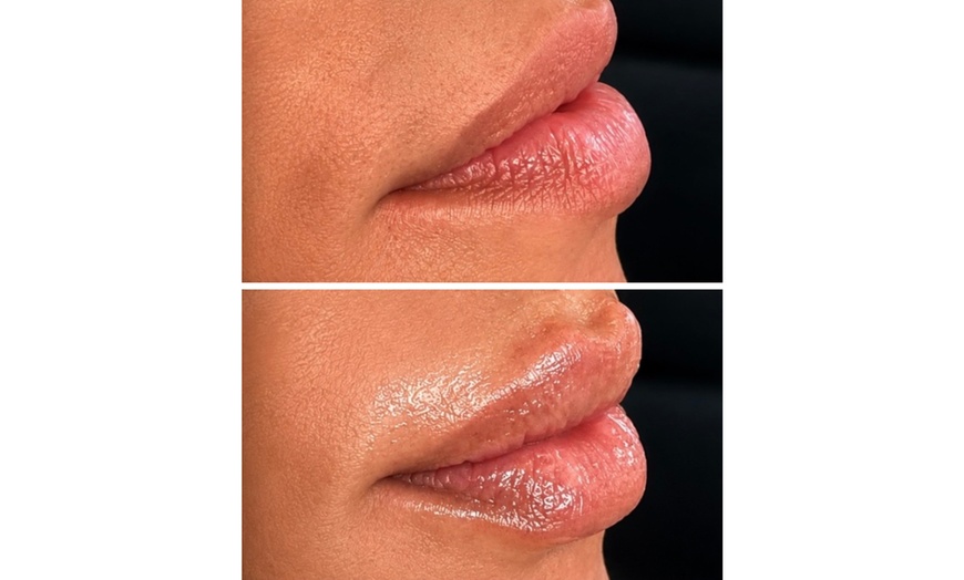 Image 6: Lip Filler and Enhancement Options Using Evolysse