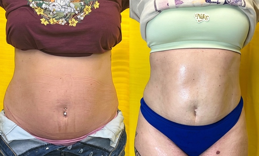 Image 3: 30-Min Body Contouring Sessions for Fat & Cellulite Reduction