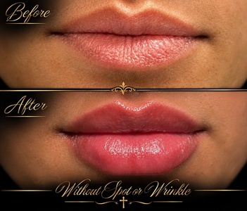 Lip Enhancement- Half Syringe of Lip Filler using Evolysse - Without Spot or Wrinkle