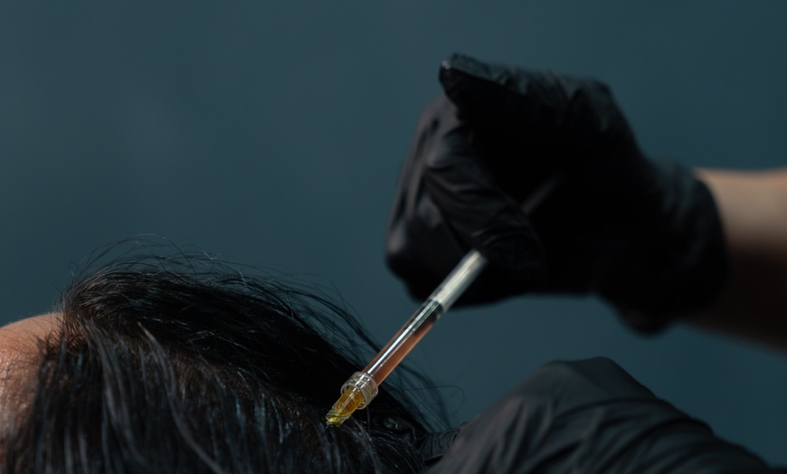 Image 9: PRP Hair Restoration for Full Head, Crown, or Hairline 