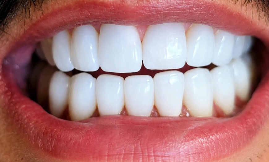 Image 2: Zoom Whitening and Teeth Cleaning Services 