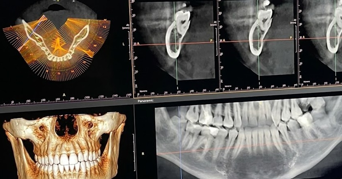 TAC dental 3D de doble arcada en Madrid