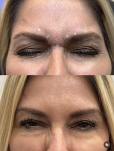 20 Units of Botox - Synerchi Medical Spa