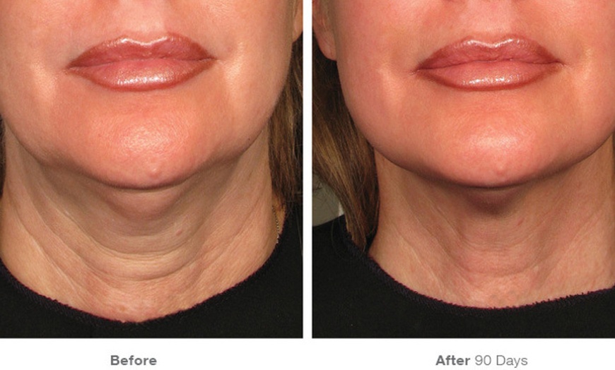 Image 4: Ultherapy: Non-Invasive Skin Lifting & Tightening for Face & Neck