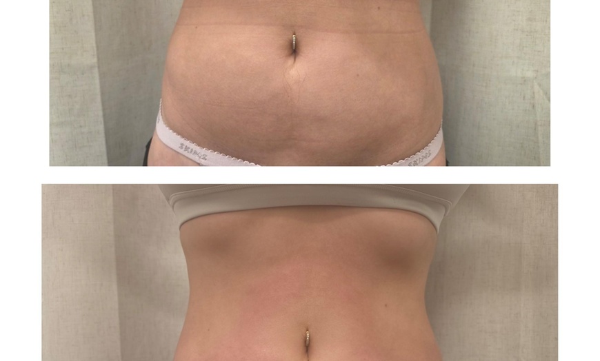 Image 6: One or Two Lymphatic Drainage with Cavitation and RF