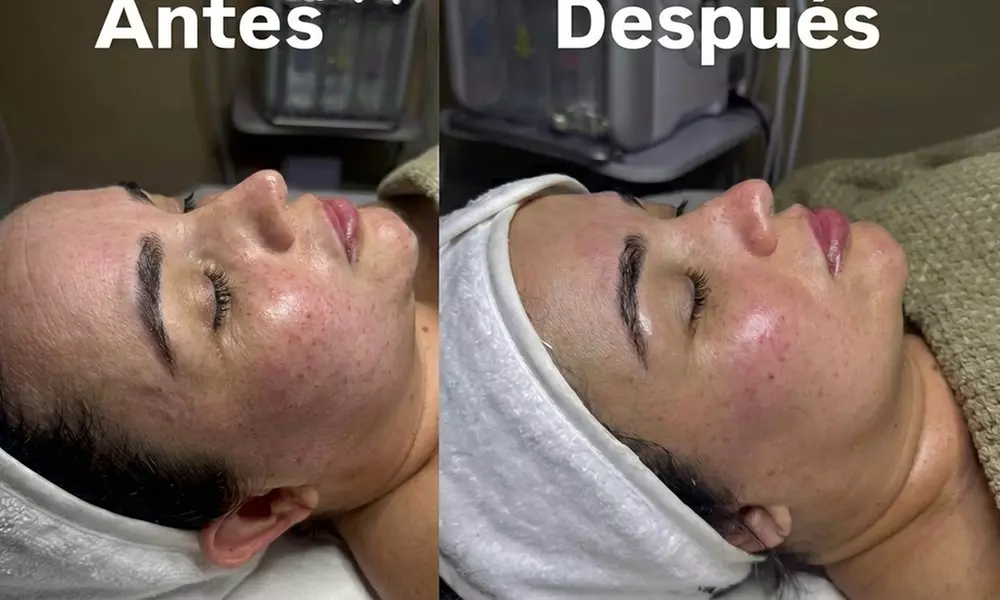 1 o 2 tratamientos faciales de limpieza de cutis y radiofrecuencia