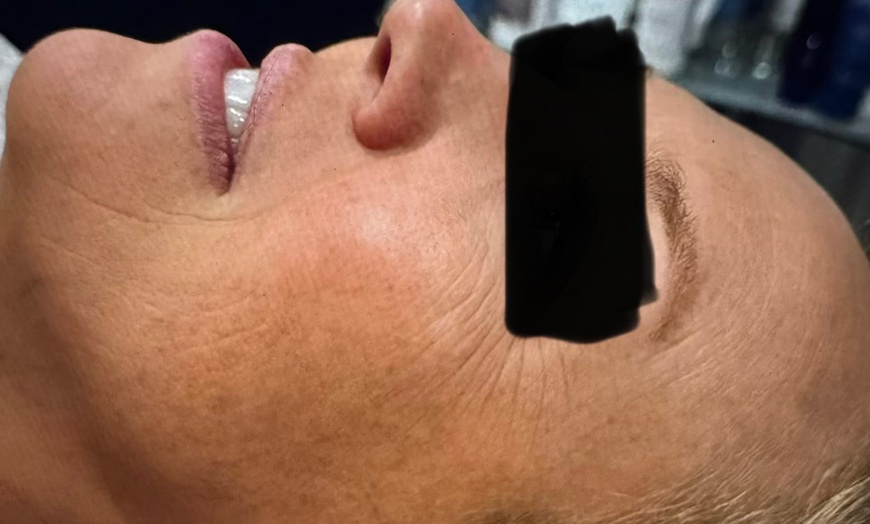 Image 2: Unleash Radiance: Transform Your Skin with a Chemical Peel Adventure!