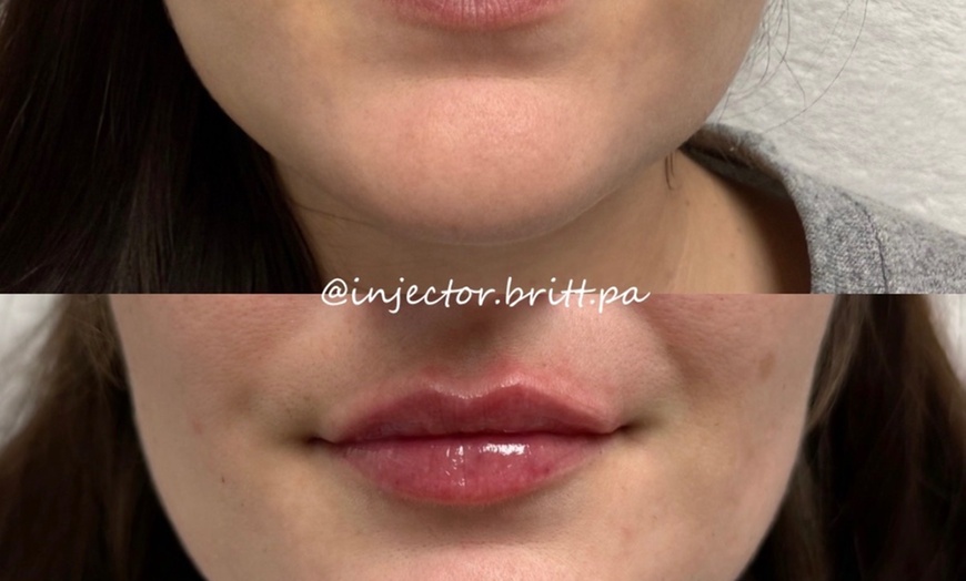 Image 13: Dermal Filler & Botulinum Toxin Treatments for Facial Rejuvenation
