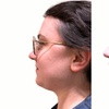 Image 1: Up to 55% Off on Chin Sculpt & Chin Sculpt Max