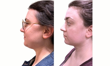 Chin Sculpt Max - Targeted Fat Reduction Plus Neck, Chin and Jawline Tightening - Your Sculpt Studio