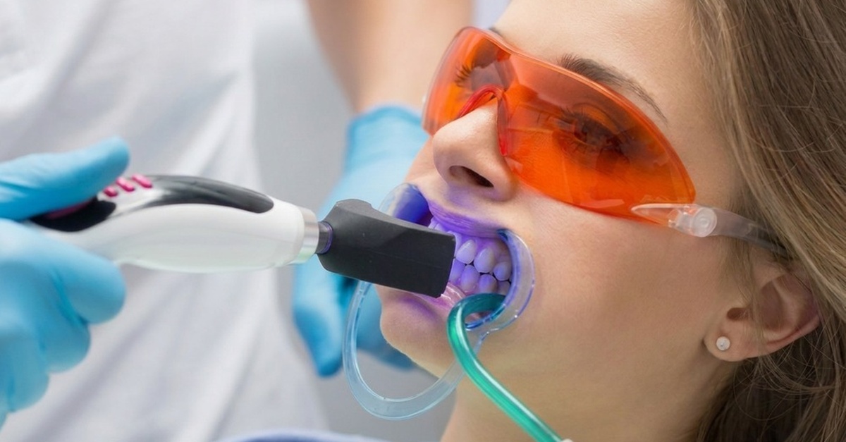 Blanqueamiento dental LED e higiene bucal con fluorización en Bilbao