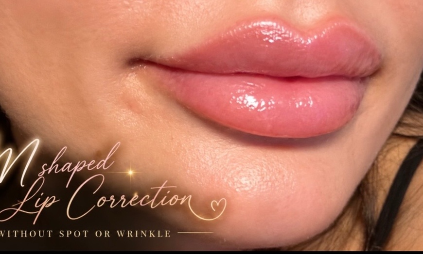 Image 6: Lip Filler and Enhancement Options Using Evolysse