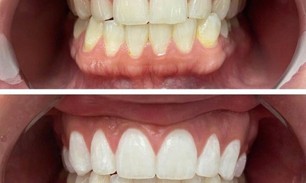 25-Minute In-Office Teeth-Whitening Session - Browology