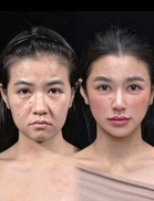 Non-surgical Full Facelift with Fotona Laser  - Up to 60% Off