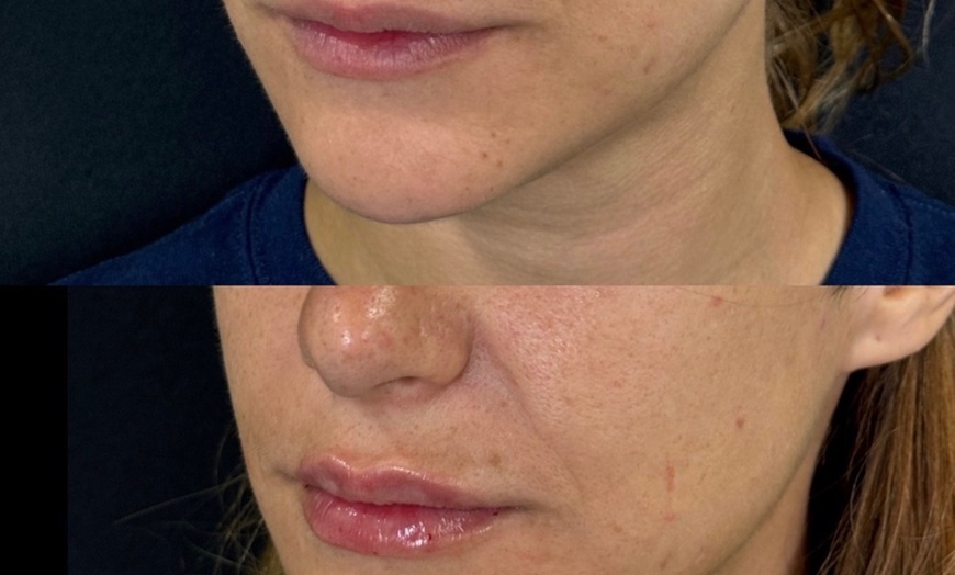 Image 12: Dermal Filler & Botulinum Toxin Treatments for Facial Rejuvenation