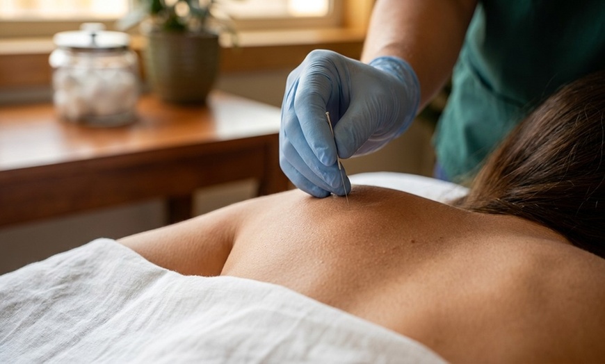 Image 4: Experience Acupuncture and Cupping for Holistic Wellness