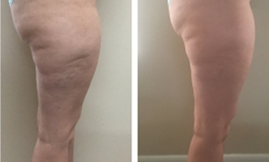 Image 10: One or Two Cavi-Lipo Fat Loss Treatments